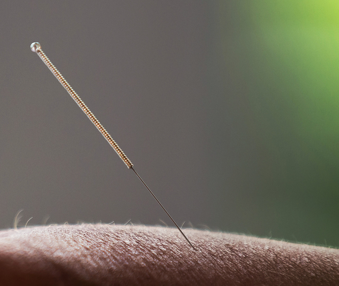 Medizinische Fotografie Rosenheim, Praxisfotografie, Fotos Naturheilkundepraxis, Fotografie Praxis für Naturheilkunde, Praxisportrait Nahaufnahme einer Akupunkturnadel in der Haut, Naturheilkundepraxis, Praxisfoto, Praxis Heilpraktikerin Ulrike Stadler